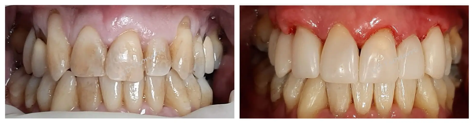 cirugía periodontal