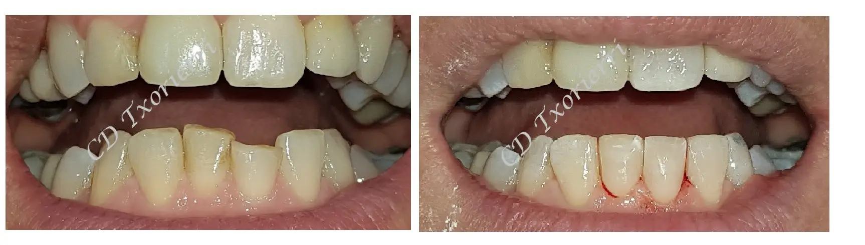 Centro Dental Txorierri CARILLAS ESTETICAS EN 1 SOLO-CASO 2 DIA 2