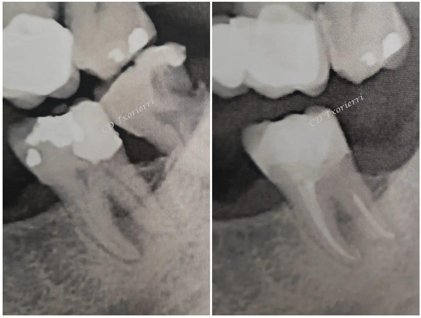 endodoncia