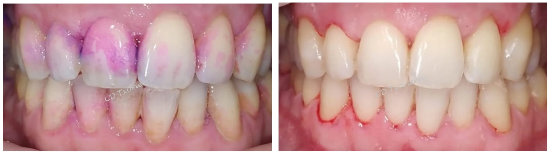 cepillado de dientes