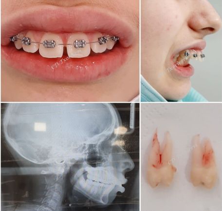 extracción ortodoncia