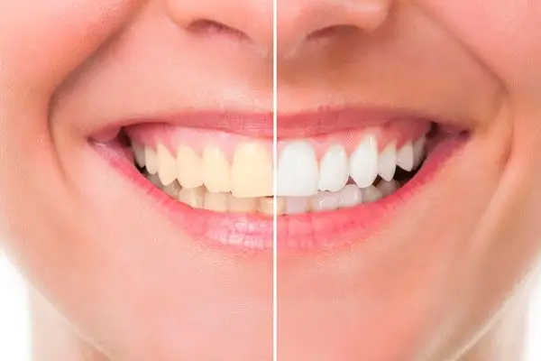 antes y despues de un blanqueamiento dental
