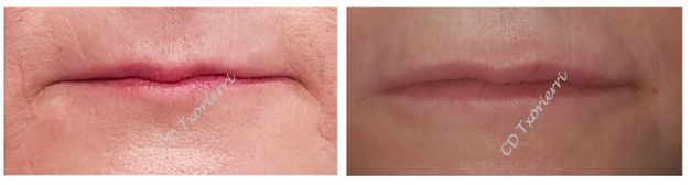  Centro Dental Txorierri AUMENTO DISCRETO DE LABIOS