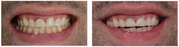 Centro Dental Txorierri BLANQUEAMIENTO Y CAMBIO DE CORONA