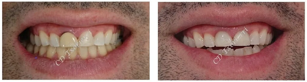 Centro Dental Txorierri BLANQUEAMIENTO Y CAMBIO DE CORONA