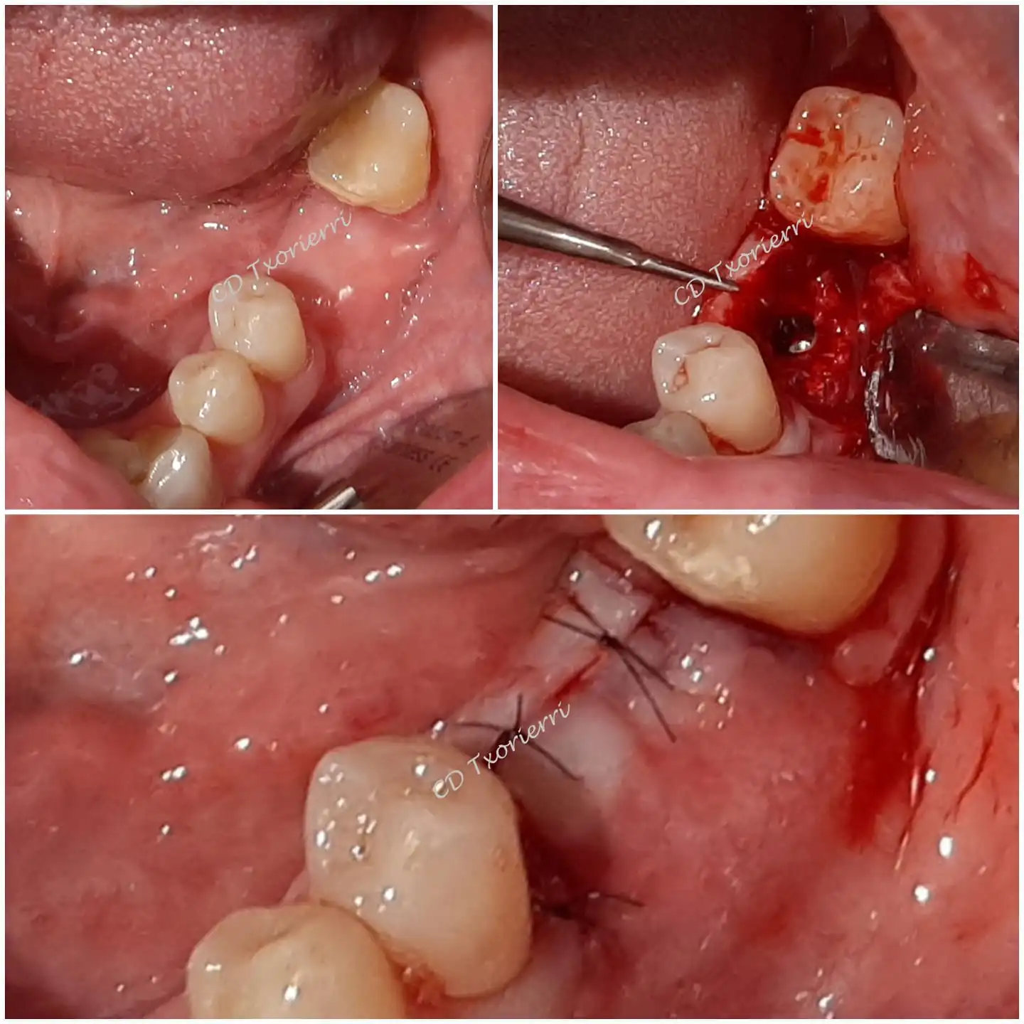 implante molar