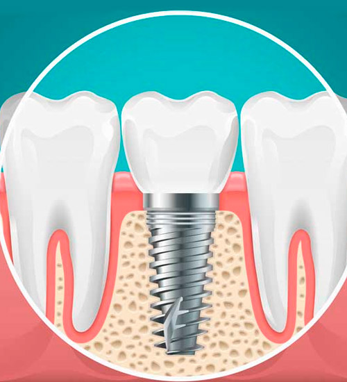 Centro Dental Txorierri implante dental